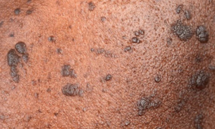 Choose Your Perfect DPN Treatment for Smoother Skin