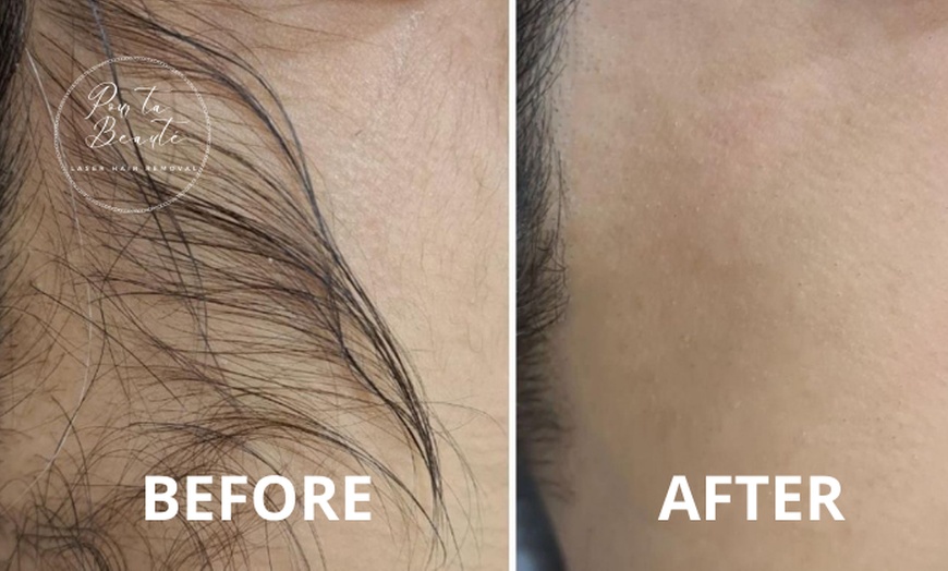 Image 7: Candela GentleMax Pro Laser Hair Removal at Pour Ta Beauté Laser Spa