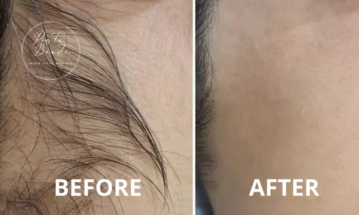 Smooth Skin w/ One Laser Hair Removal for Under Arms, Full Face, Full Brazilian, Mankini & More (Up to 60%Off)  - Primary Image