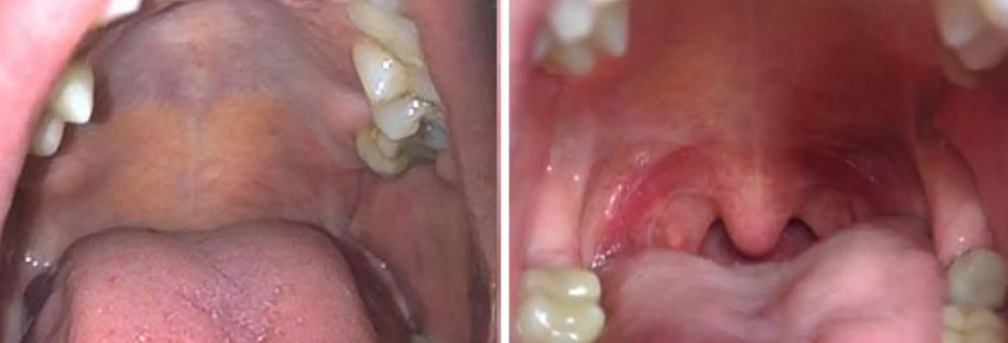 One Session of Sleep Apnea/Snoring Correction Laser at Nidraveda PA