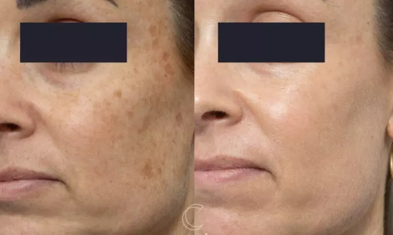 Up to 65% Off PicoWay Resolve Skin Resurfacing Face Treatments
