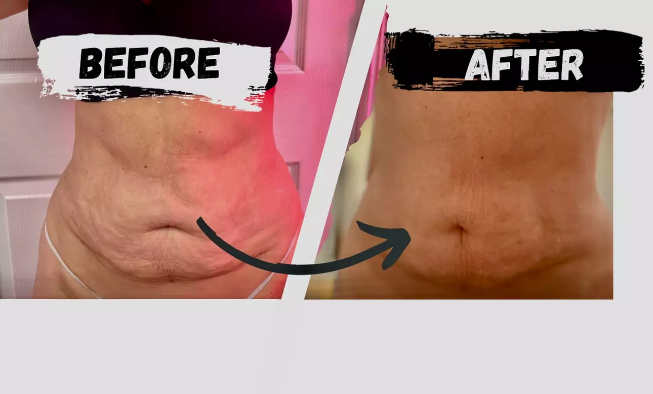 Smoother Contours with One or Two Non Invasive Laser iLipo + Cavitation & Wood Therapy @Bare Skin (Up to 87%Off)