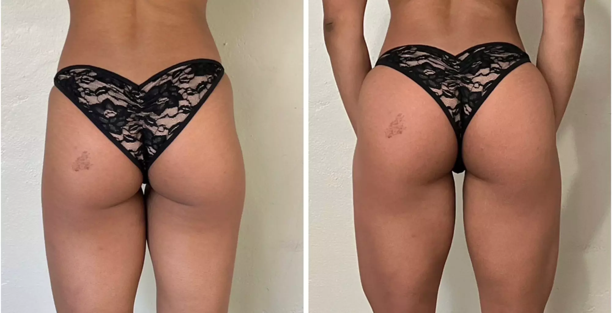 Experience a Brazilian Butt Lift with EMS Technology