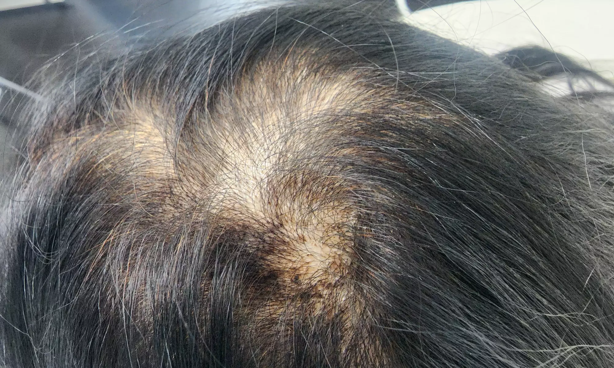 Boost Hair Growth with PRP Hair Restoration Treatments