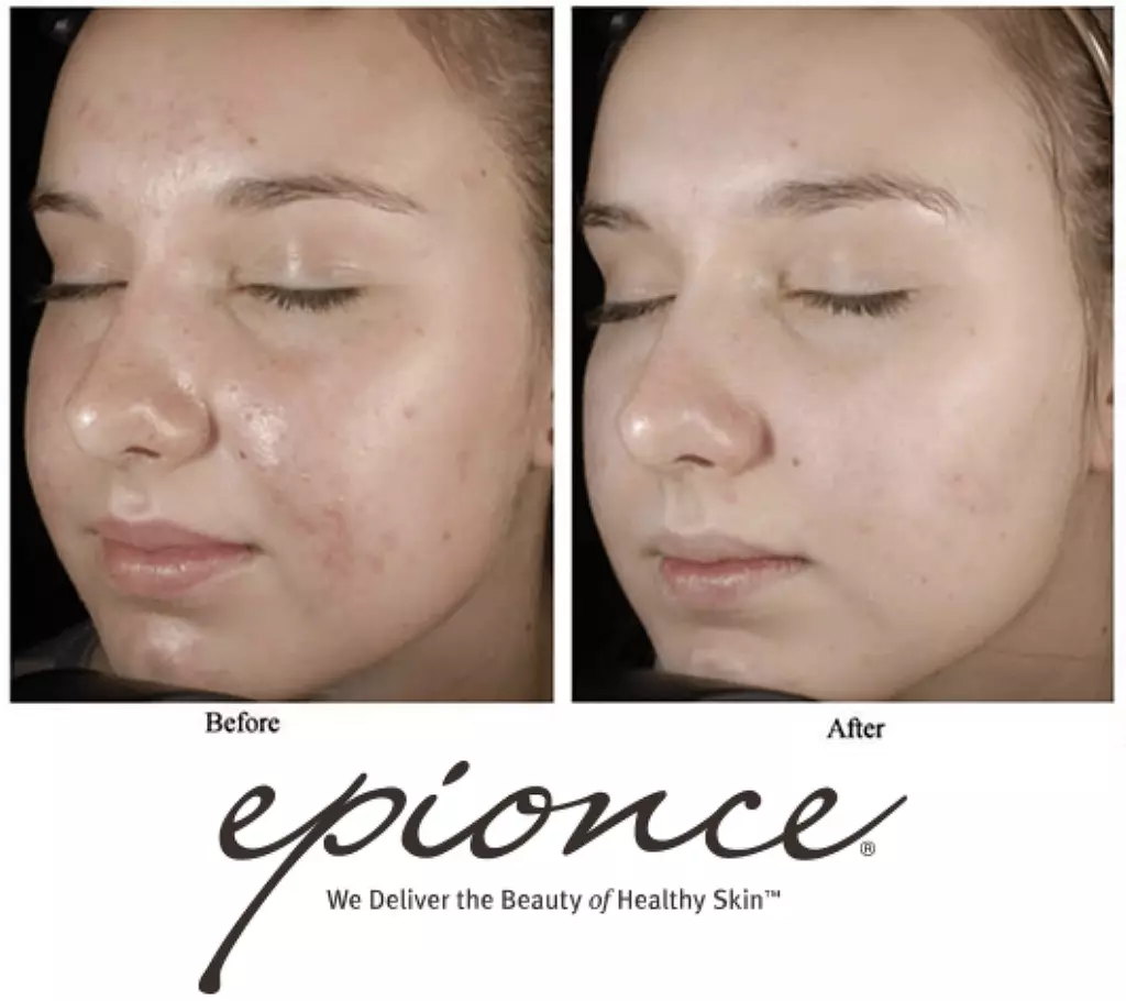 Up to 50% Off on Facial - Chemical Peel at Bel Lavi Medical Aesthetics - Primary Image