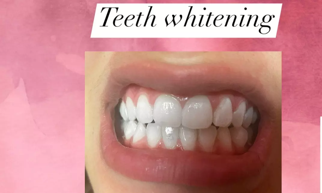 Whiten Your Smile with One or Two Teeth Whitening Treatments
