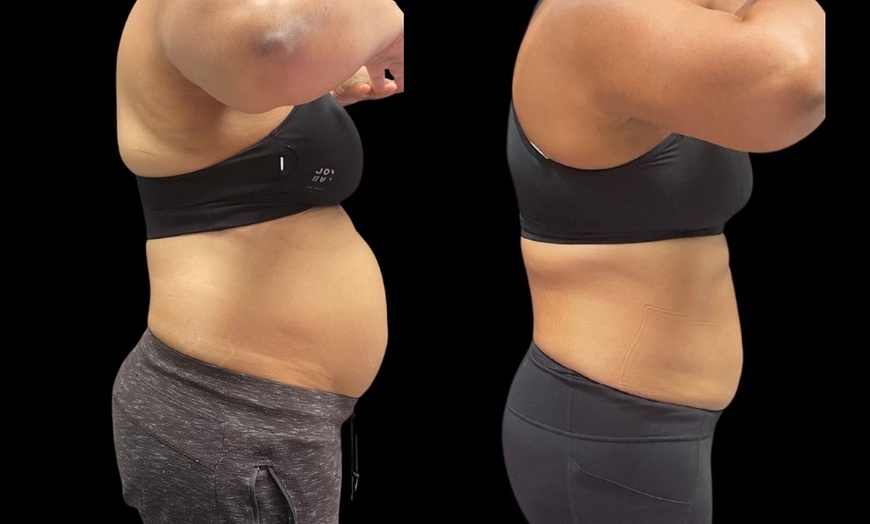 Image 1: Up to 55% Off on Ultrasonic Fat Reduction at Southern Shapez