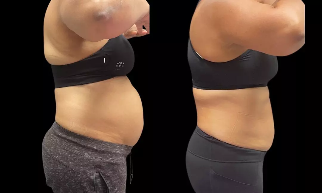 Slim Down with Body Sculpting and Cellulite Treatments