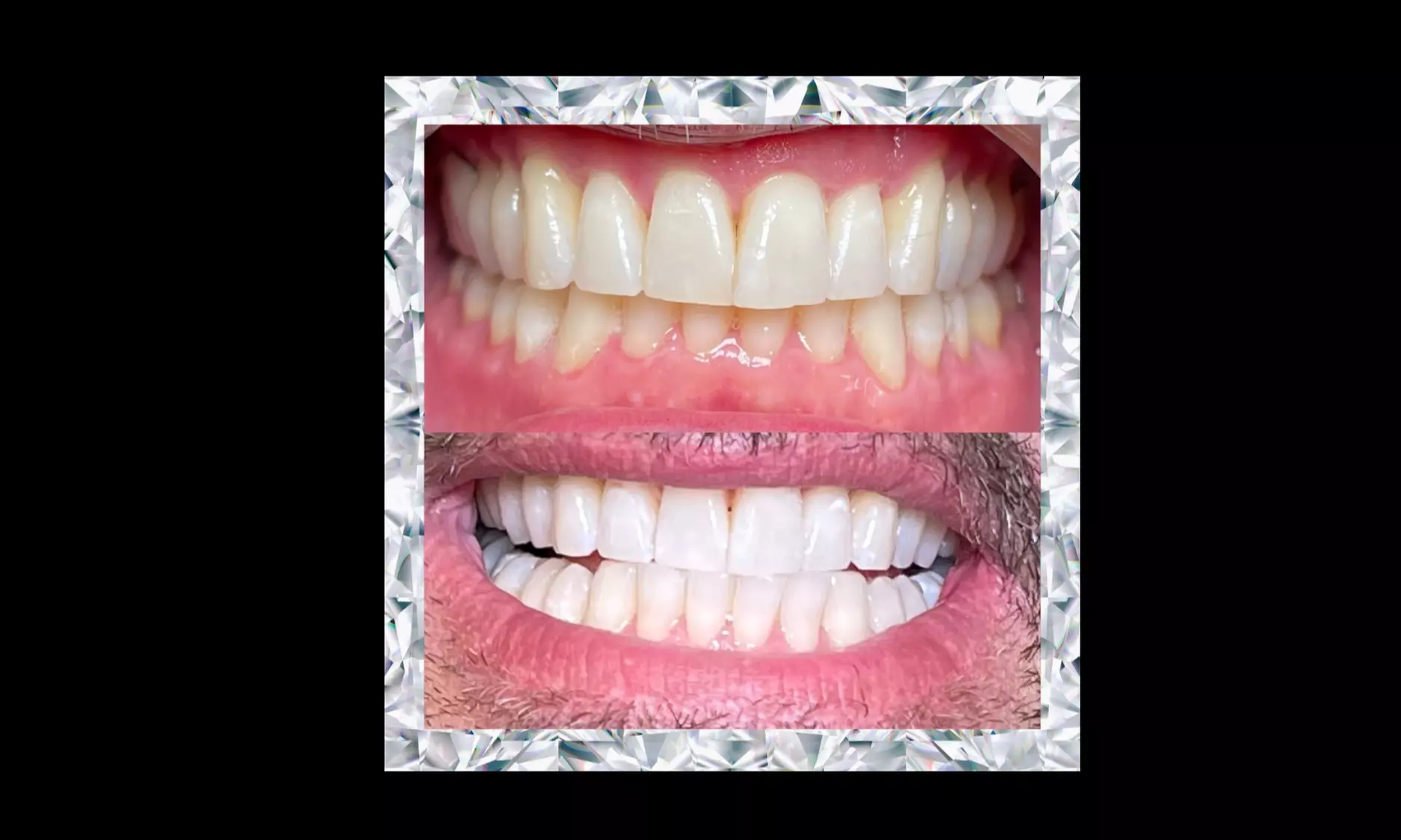Up to 51% Off on Teeth Whitening - In-Office - Non-Branded at PLATINUM +Teeth Whitening - Second Medium