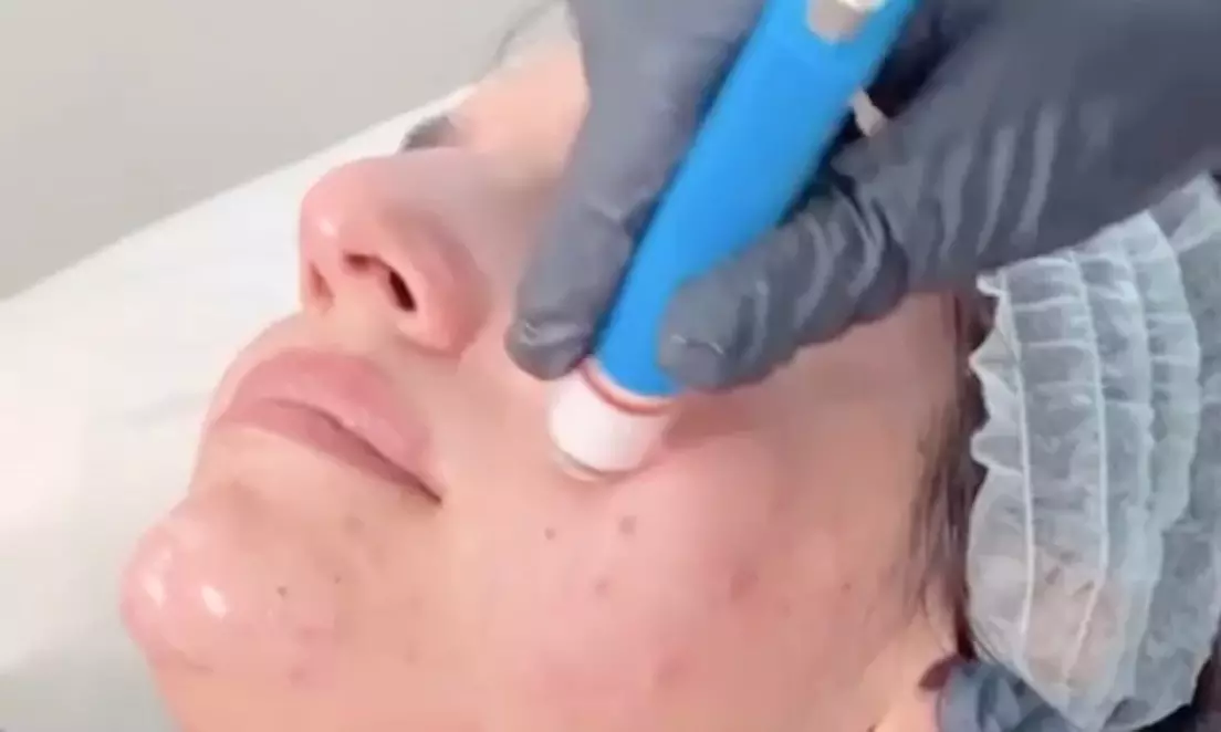 Up to 20% Off on Microdermabrasion at Luminous Luxe Spa - Second Medium