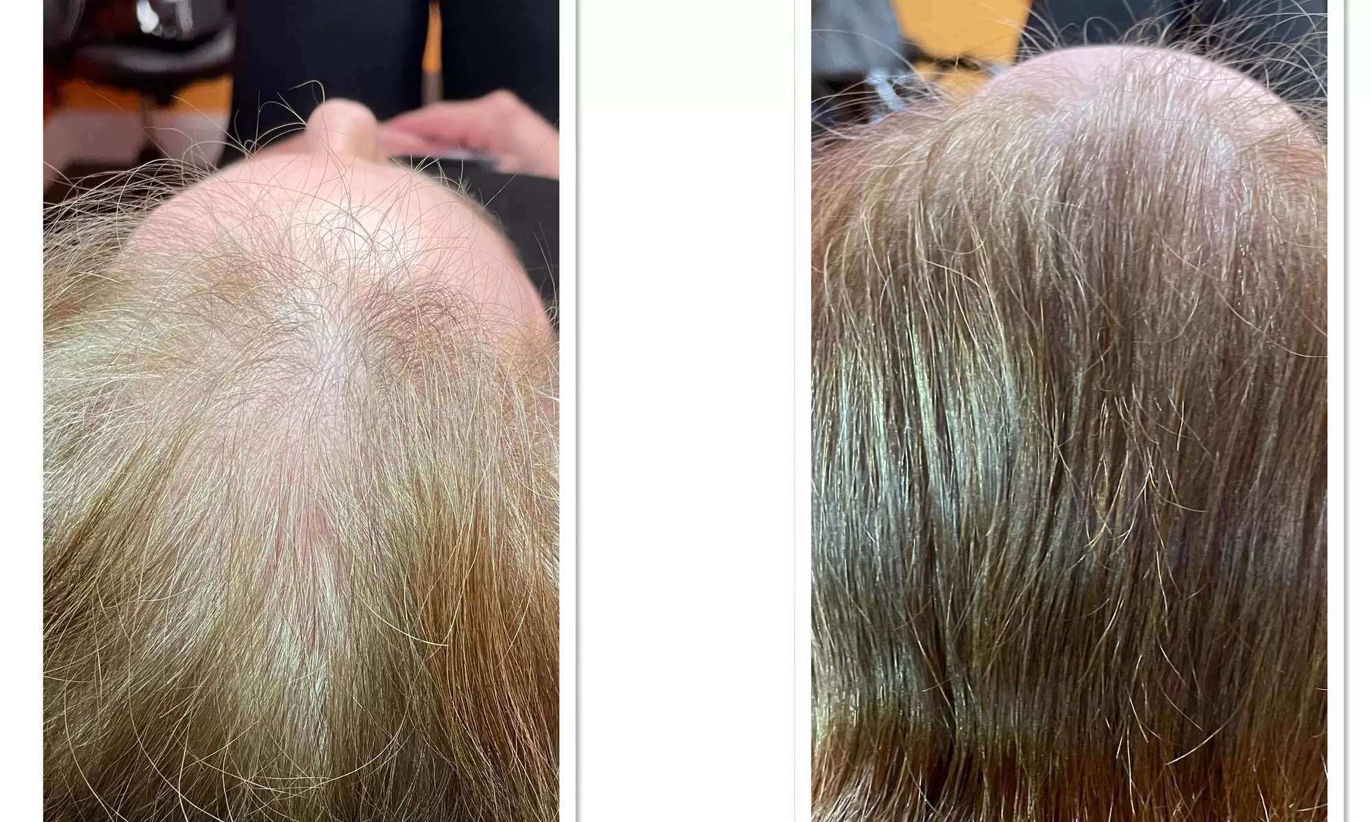 Up to 50% Off on Salon - Scalp Care at Elite SMP - Second Medium