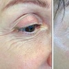 Image 3: One Fibroblast Plasma Session on Choice of Treatment Areas