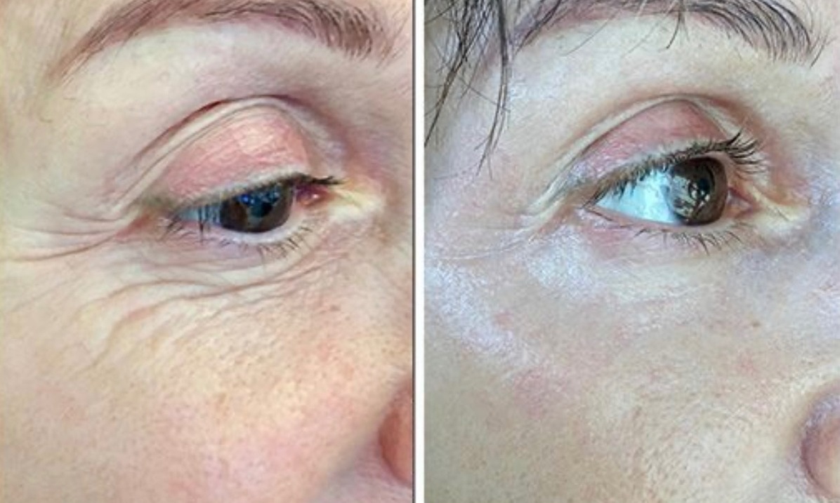 One Fibroblast Plasma Session on Choice of Treatment Areas