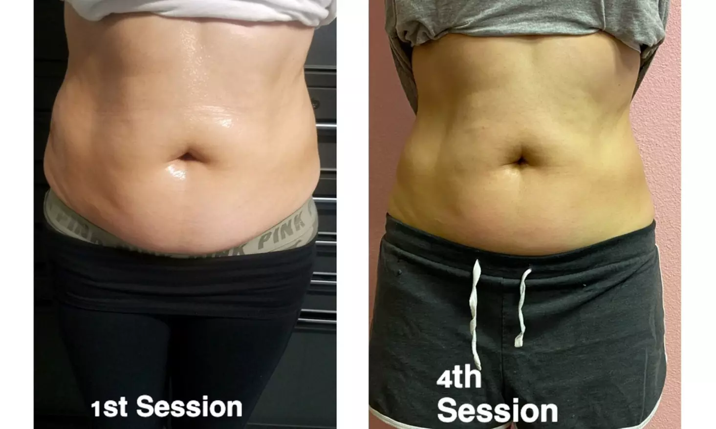 Experience Non-Invasive Laser Lipo at Mia Rose Body Sculpting with Various Options Available and Up to 25% Off - Primary Image