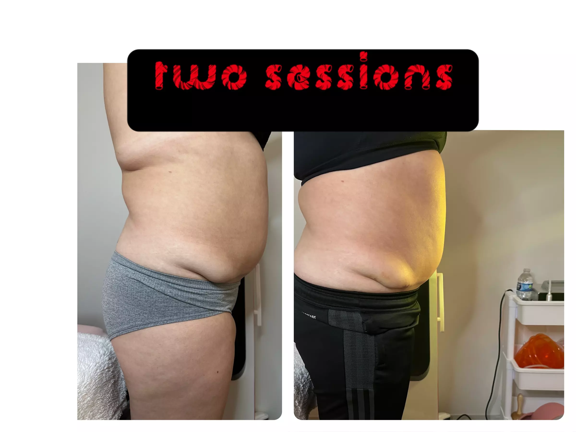 Ultrasonic Body Sculpting Sessions at Dyamond sculpted