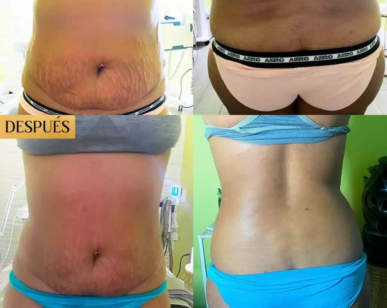 Up to 30% Off on Ultrasonic Fat Reduction at M Gold Beauty Spa