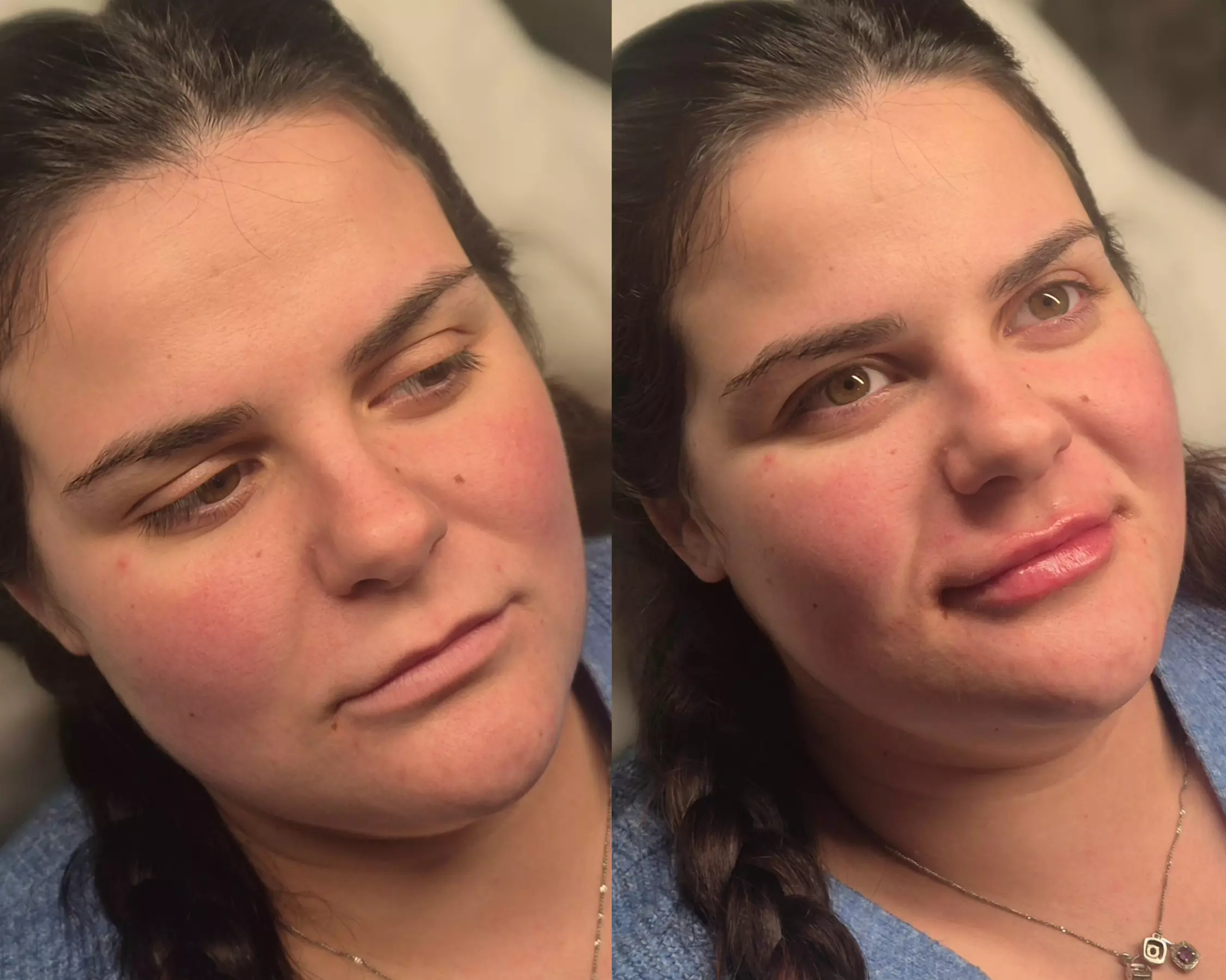 Dermal Filler Treatments to Enhance & Define Facial Features