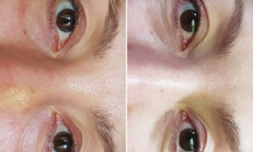 Image 1: Skin or Hair Rejuvenation with 3 Sessions of Polynucleotide Injections