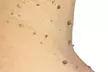 Skin Tag Removal at Philosophy of Beauty Universal - Second Medium