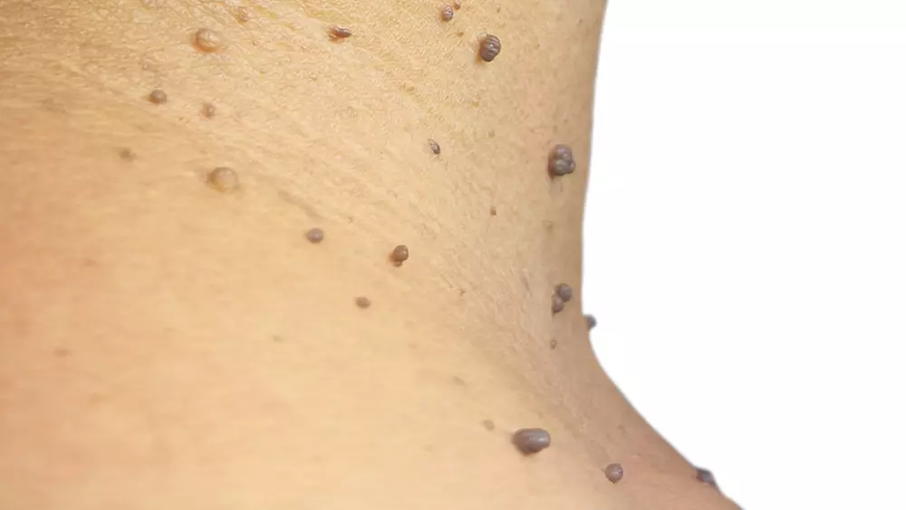 One-Three, Four-Six, and Seven-Nine Skin Tag Removal