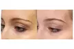 Up to 55% Off on Non Surgical Plasma Fibroblast SkinTightening Upper and Lower Eyelid Lift - Second Medium