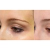 Image 4: Up to 55% Off on Non Surgical Plasma Fibroblast SkinTightening