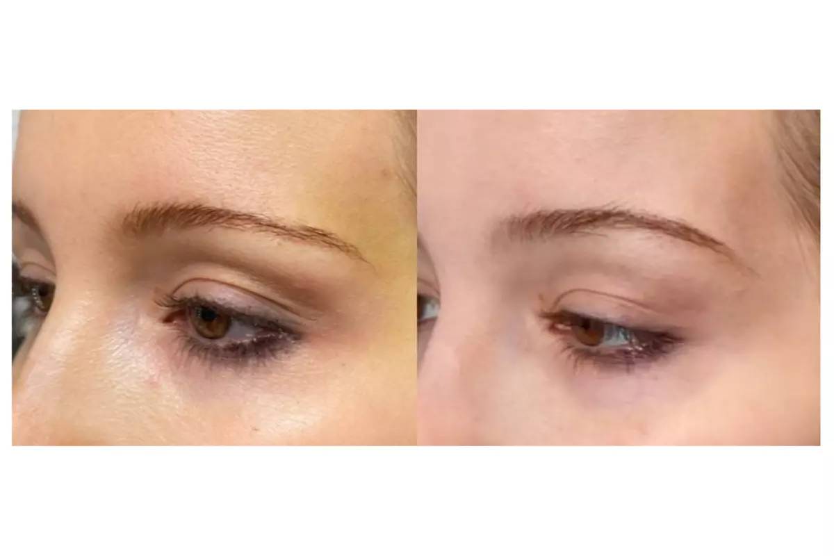 Up to 50% Off on Non Surgical Plasma Fibroblast SkinTightening