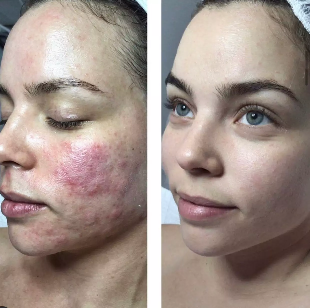 Up to 56% Off on Micro-Needling at The Skin Therapist - Primary Image