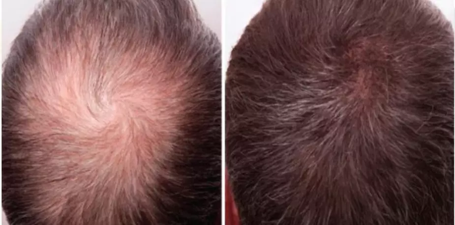 Up to 40% Off on Hair Restoration - Non-Surgical at Brows By Leah LLC - Primary Image