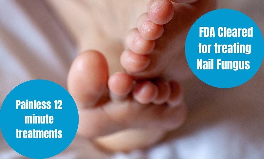 Image 1: Up to 64% Off on Toe Fungus Treatment at 21st Century Podiatry