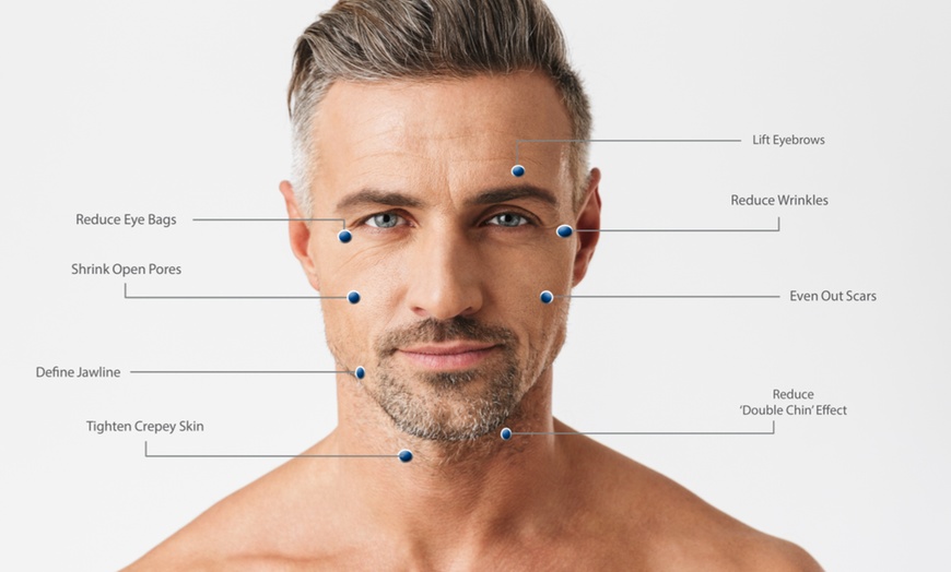 Image 9: Lift & Define: One Mid or Lower Face HIFU Face Lift