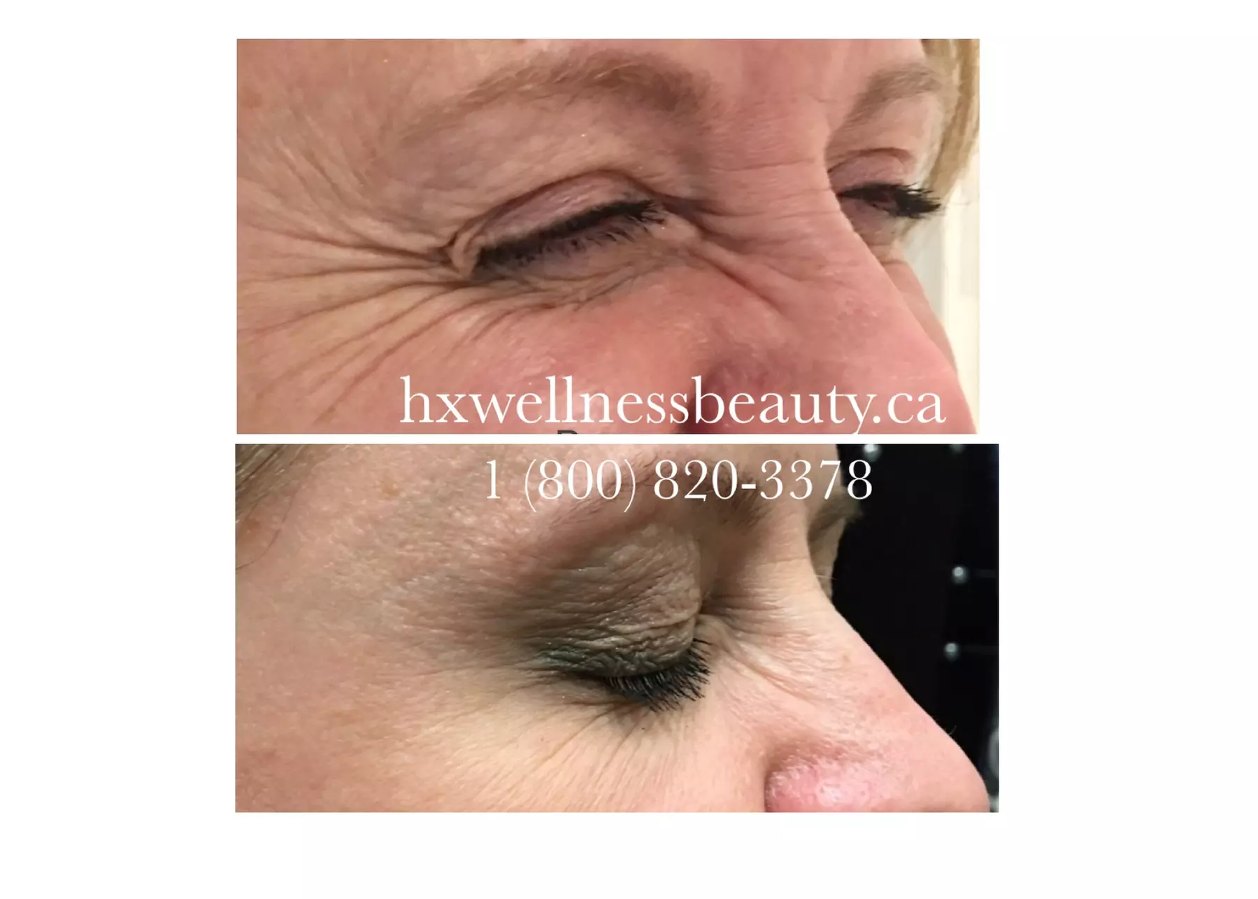 Up to 10% Off on Injection - Botox at HXWELLNESSBEAUTYSALON