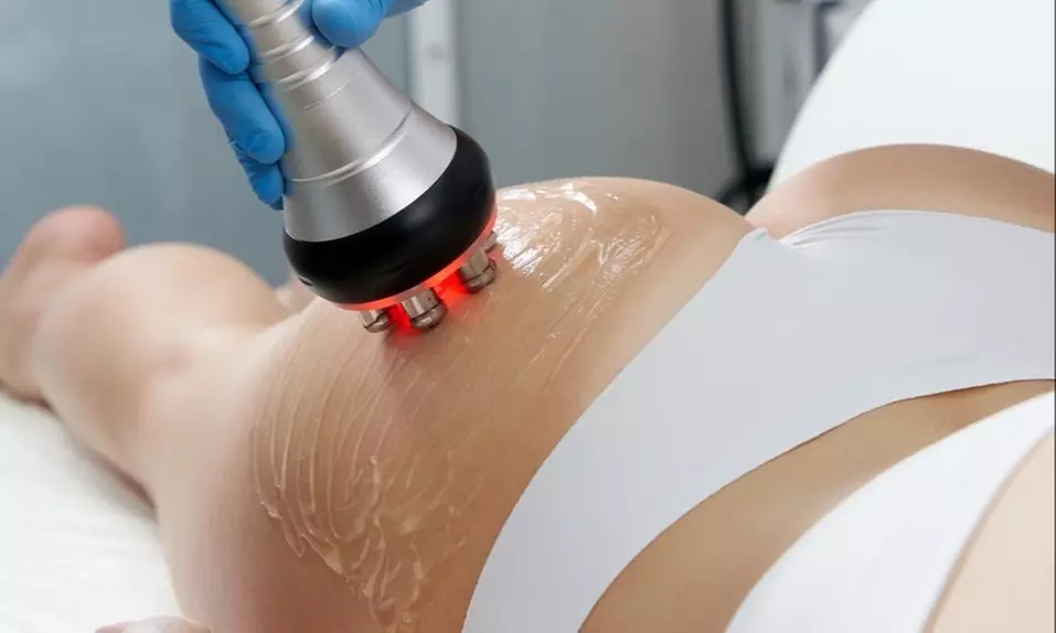 Up to 55% Off on Radio Frequency Skin Tightening at Benefit Aesthetics - Primary Image