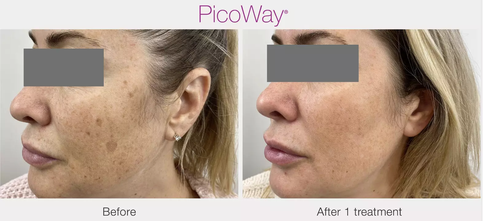 Experience PicoWay Laser Skin Resurfacing Treatment