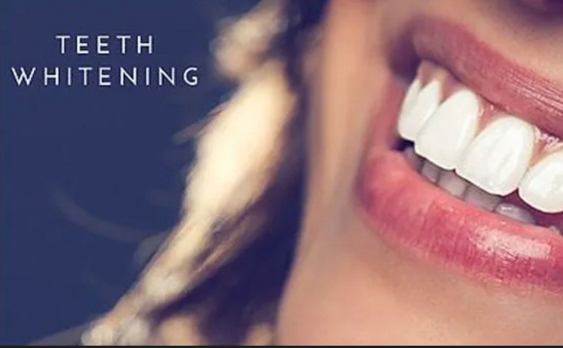 Up to 53% Off on Teeth Whitening at Sun Studio Tan