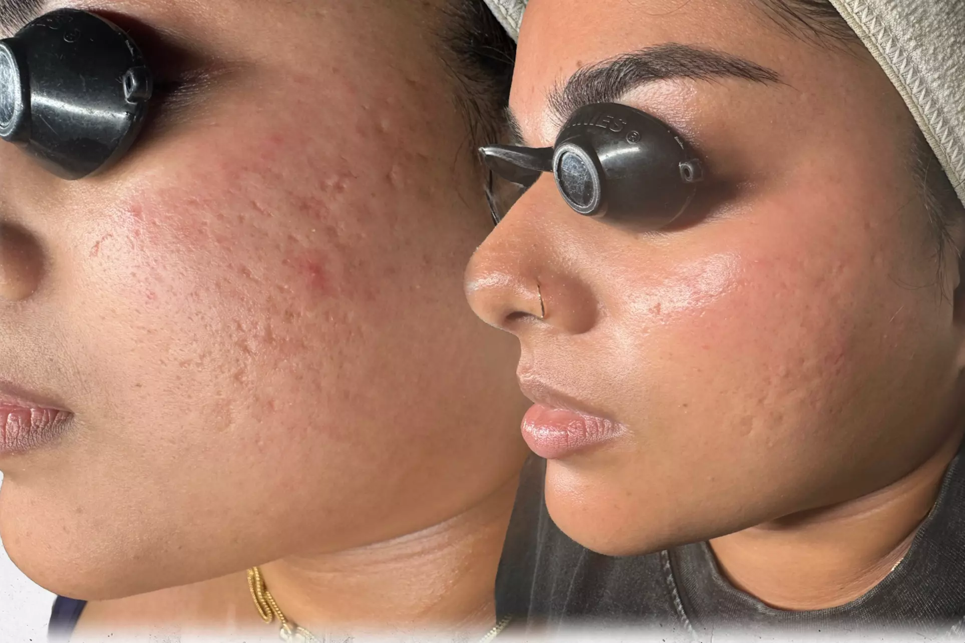 Lavish Divine offers Micro-channeling treatments for new clients, up to 51% off - Primary Image