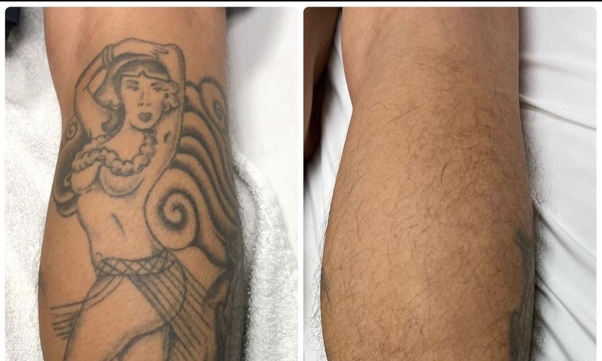 Enjoy One Laser Tattoo Removal Sessions on Different Areas