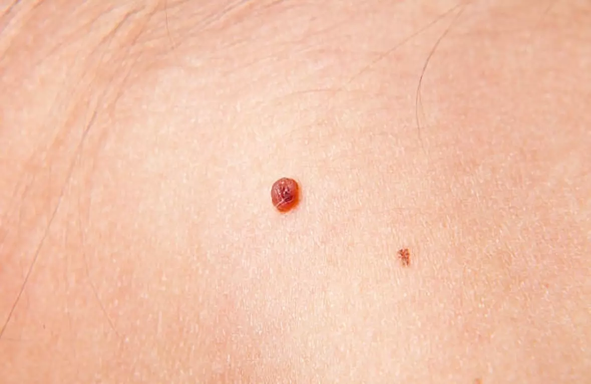 Up to 60% Off on Milia, Cherry Angiomas and Skin Tag removal