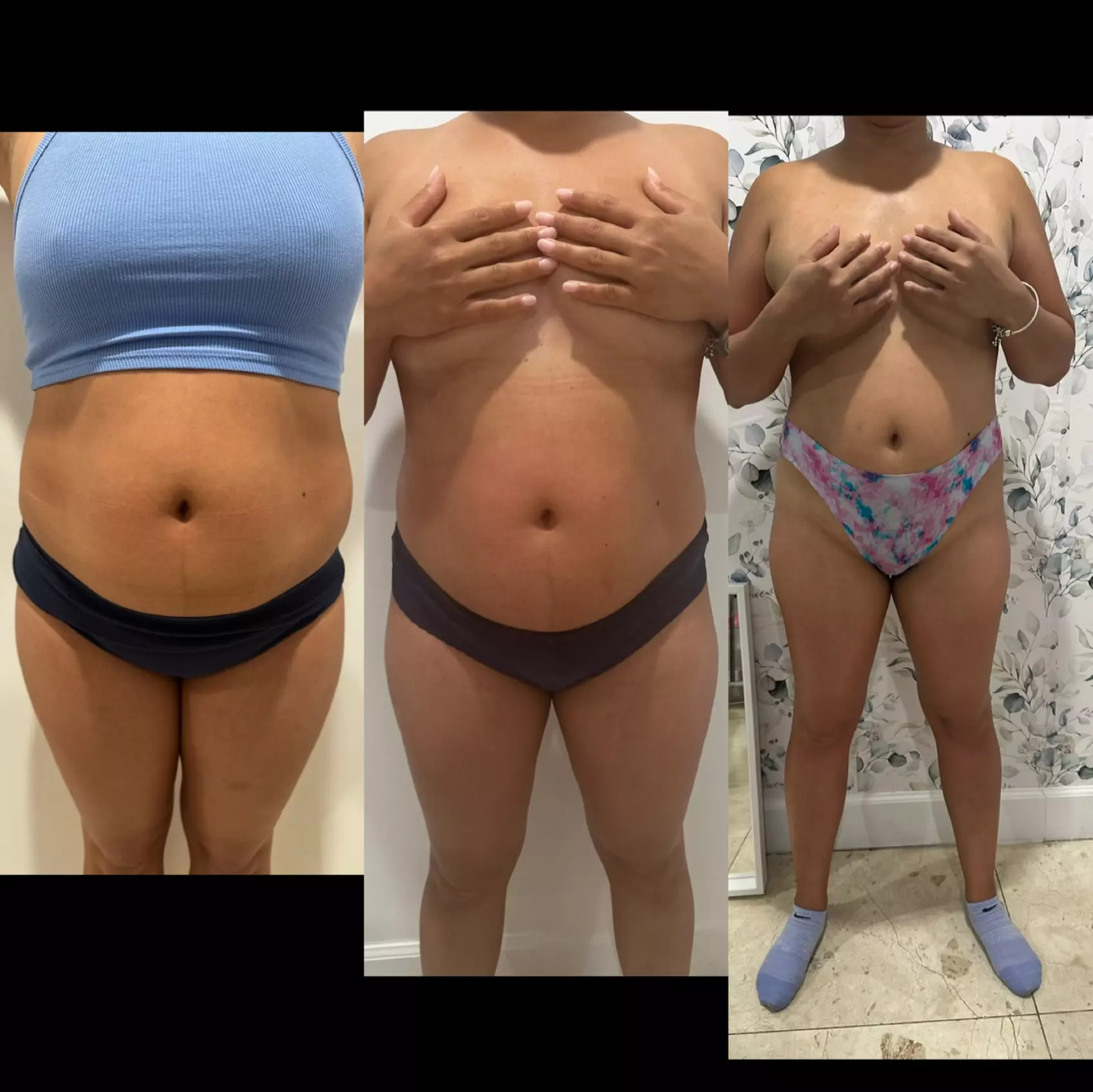 Up to 51% Off on Ultrasonic Fat Reduction at Soleil med spa
