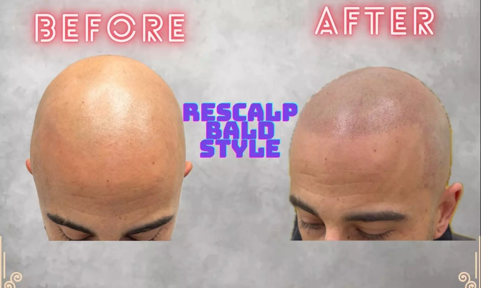 Up to 90% Off on Hair Restoration - Non-Surgical at ReScalp SMP | Scalp Micropigmentation - Primary Image