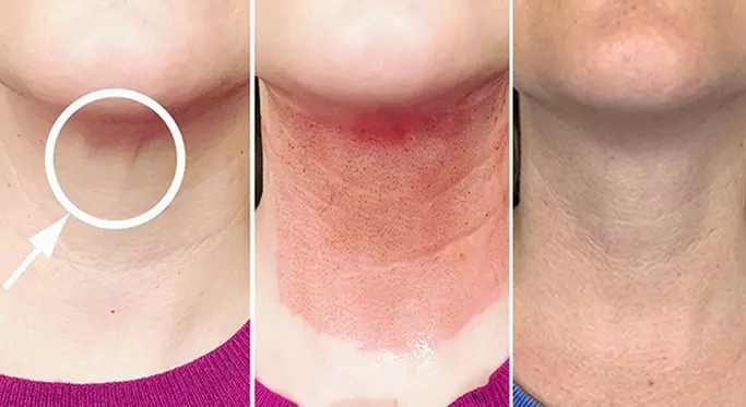 Up to 54% Off on Facelift - Non-Surgical at 11 - 11 Beauty Studio