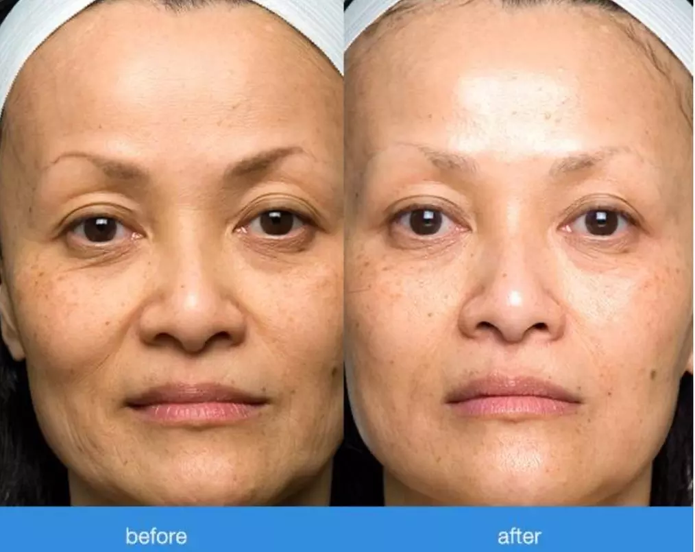 Up to 60% Off on Facelift - Non-Surgical at Skinty - Primary Image