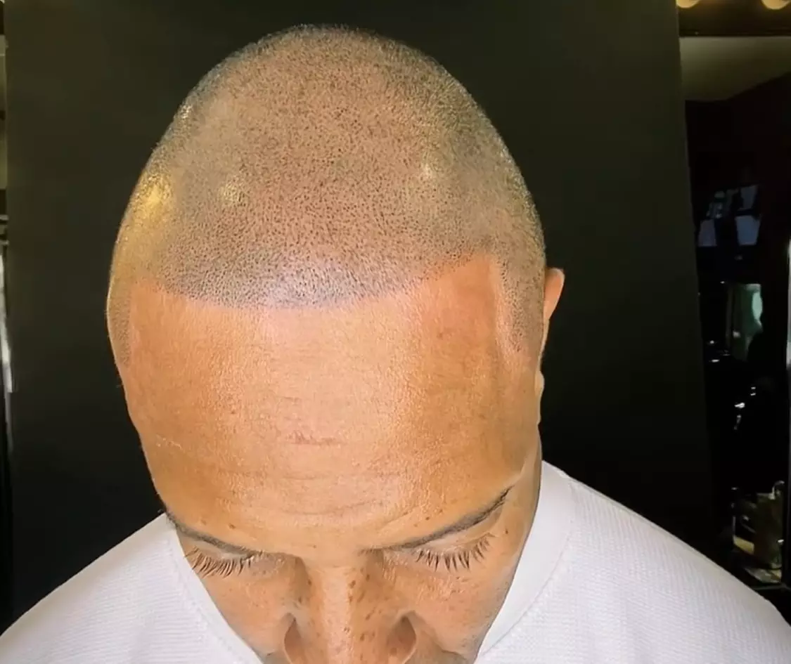 Scalp Micro Pigmentation Sessions for Hair Restoration