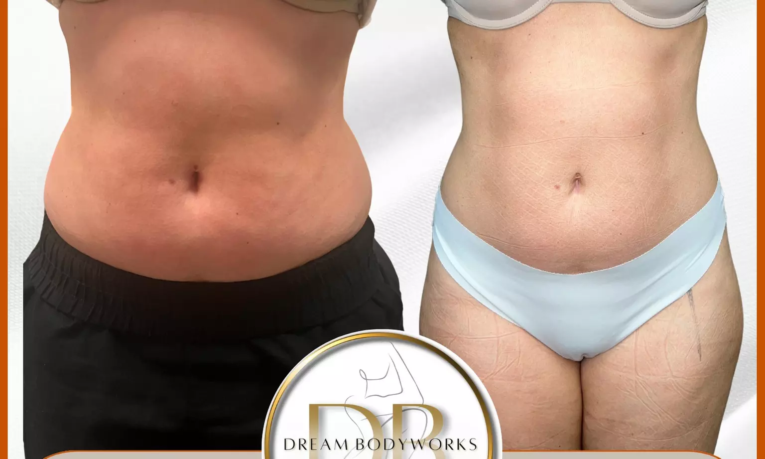 Up to 53% Off on Lymphatic Drainage Massage at Dream Bodyworks Llc