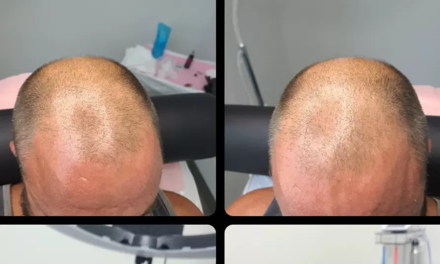 Up to 30% Off on Hair Restoration - Non-Surgical at Modern Hair SMP, LLC - Primary Image