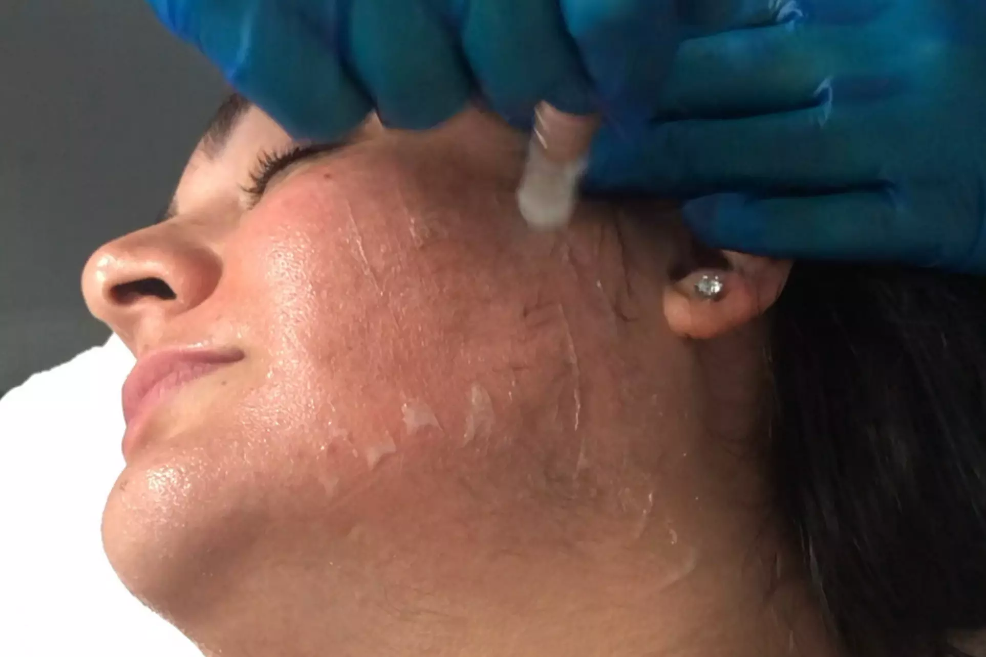 Discover holistic healing with Acutrition's acupuncture, fire cupping, and microneedling sessions up to 50% off - Second Medium
