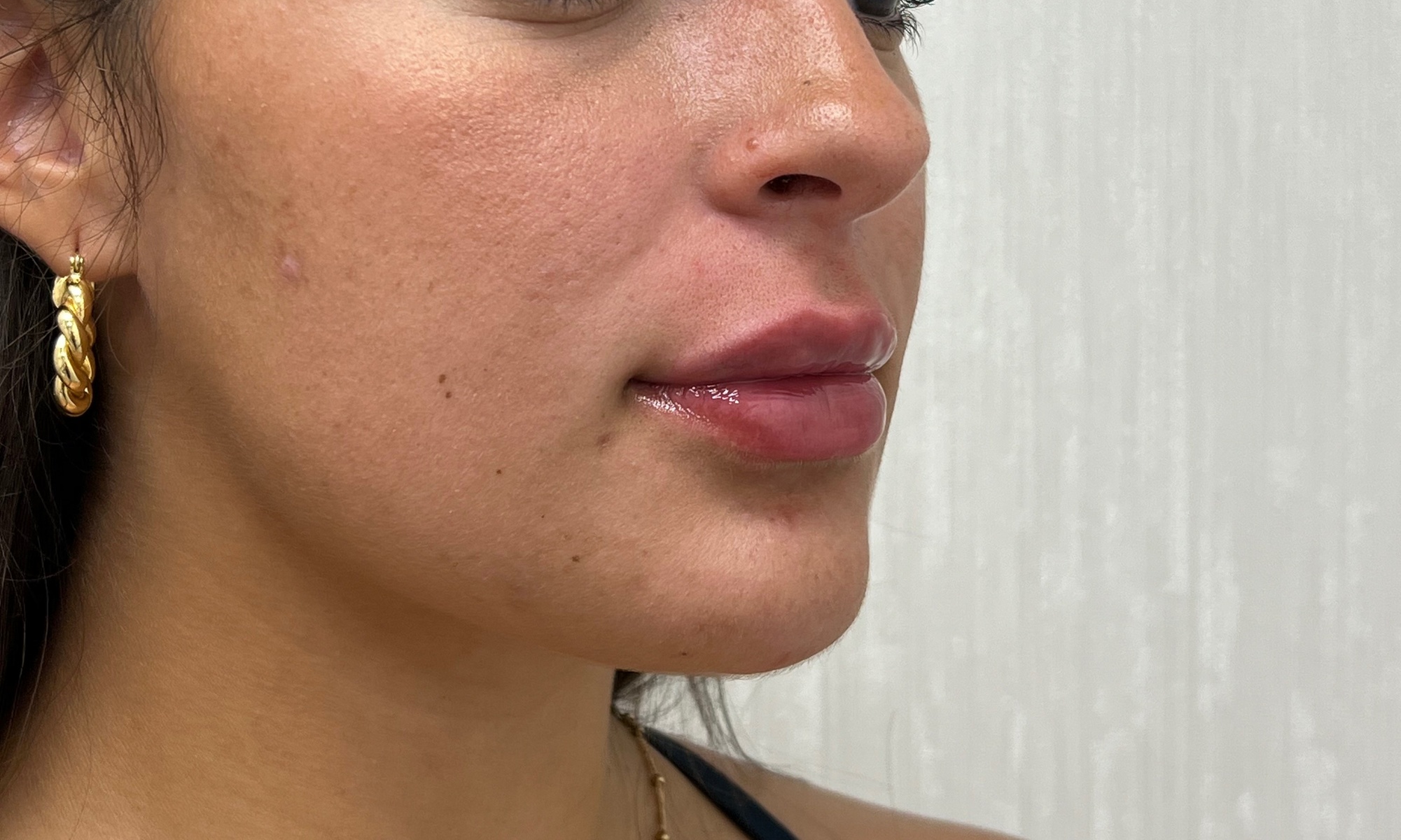 Pucker Up! Transform Your Smile with Irresistible Lip Enhancements!