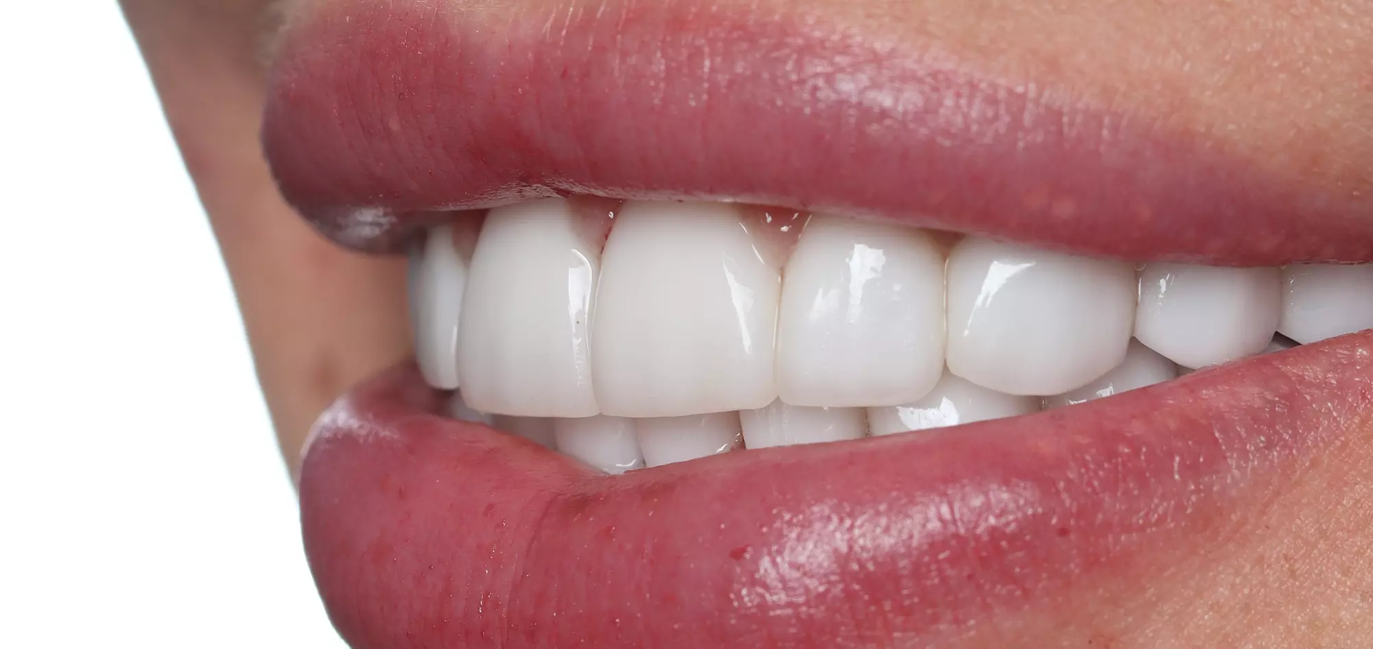 Get a Comprehensive Dental Exam with X-Rays and Cleaning for 1 or 2 at Modern Smile Design (Up to 82% Off) - Second Medium