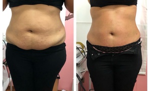 Ultrasonic Fat Reduction