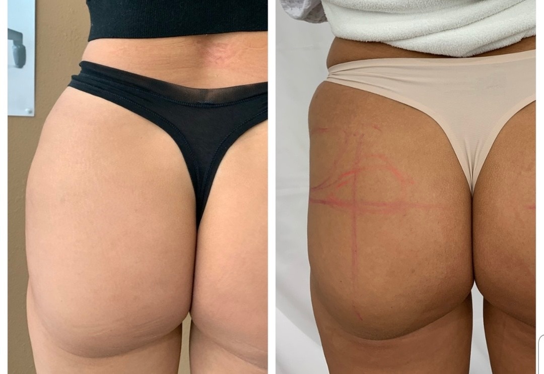 Up to 50% Off on Injection - Sculptra at Tiara Skin & Hair